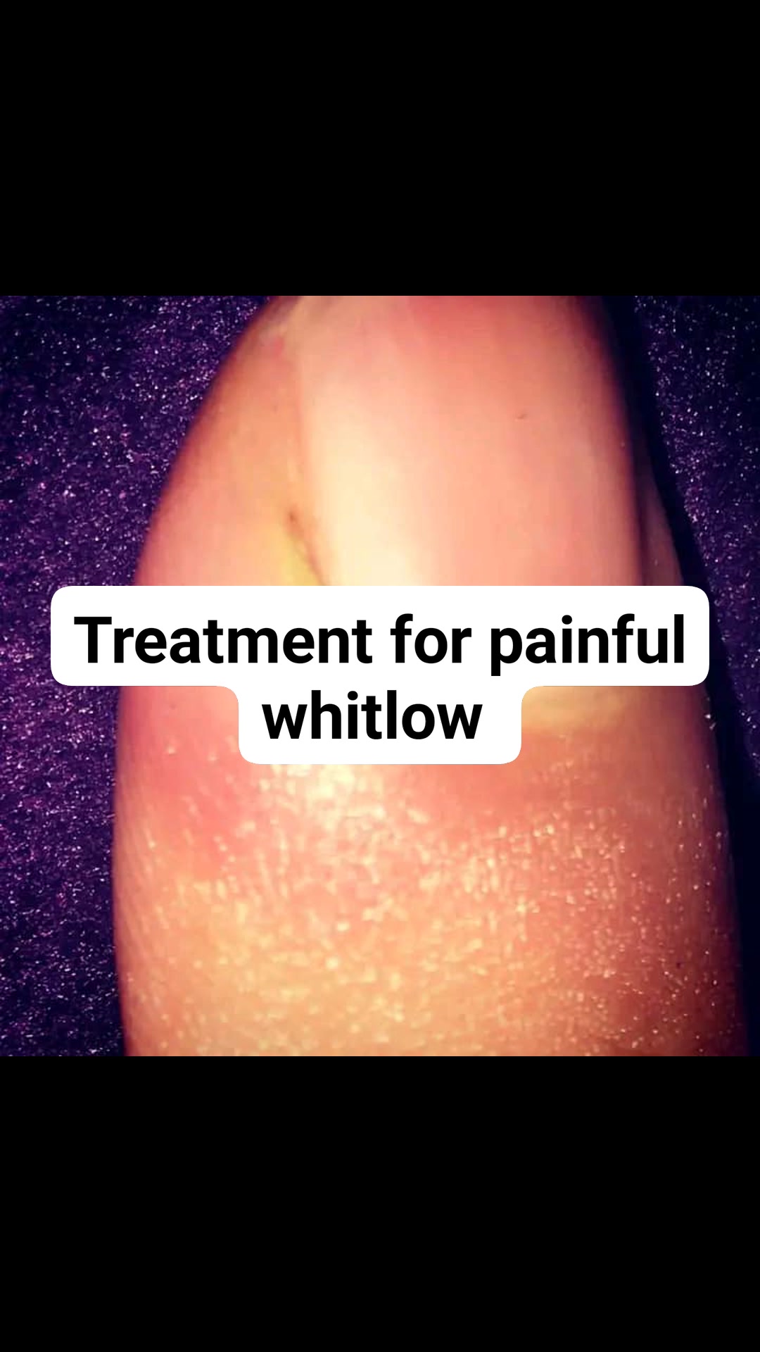 TREATMENT FOR PAINFUL WITLOW!, Whitlow is a very painful and infectious viral disease of the thumb and fingertips. Rarely, it infects the toes and nail cuticle. It is a self-limiting disease and it is