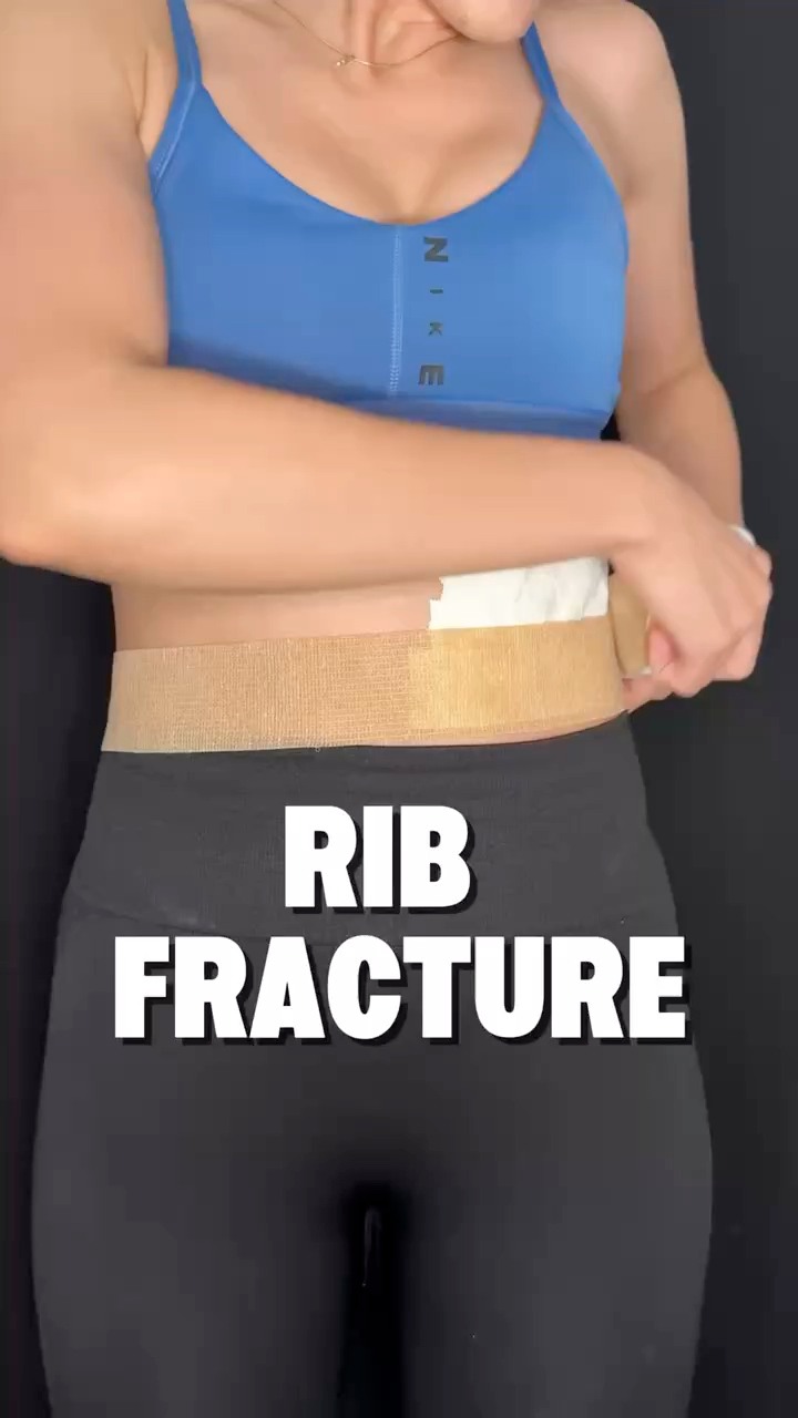 Rib fractures most commonly occur due to direct trauma to the chest ...