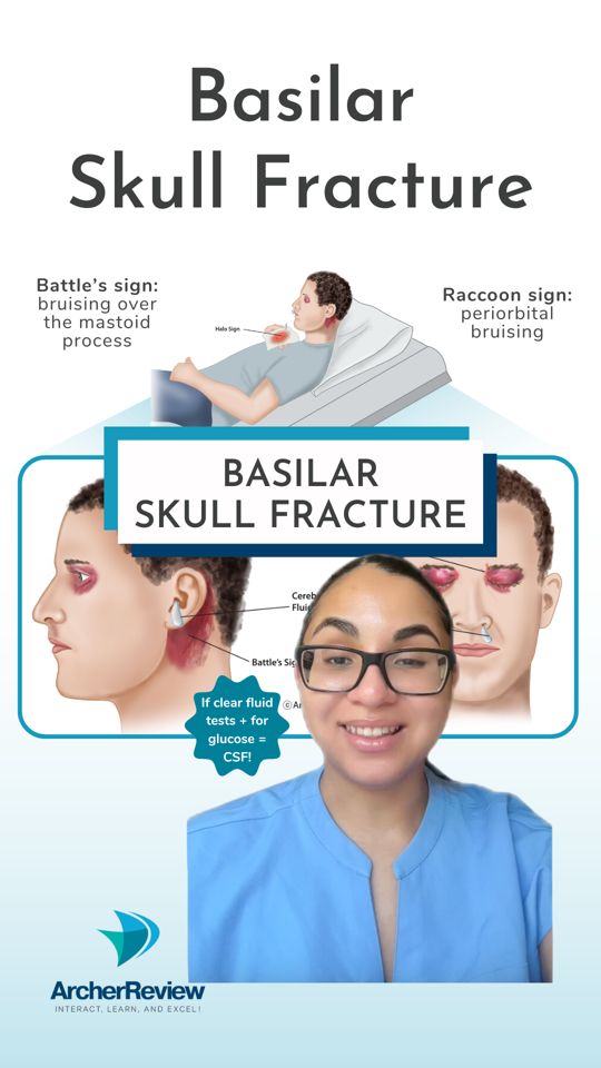 A basilar skull fracture happens when there is a fracture 🚫 to the base ...