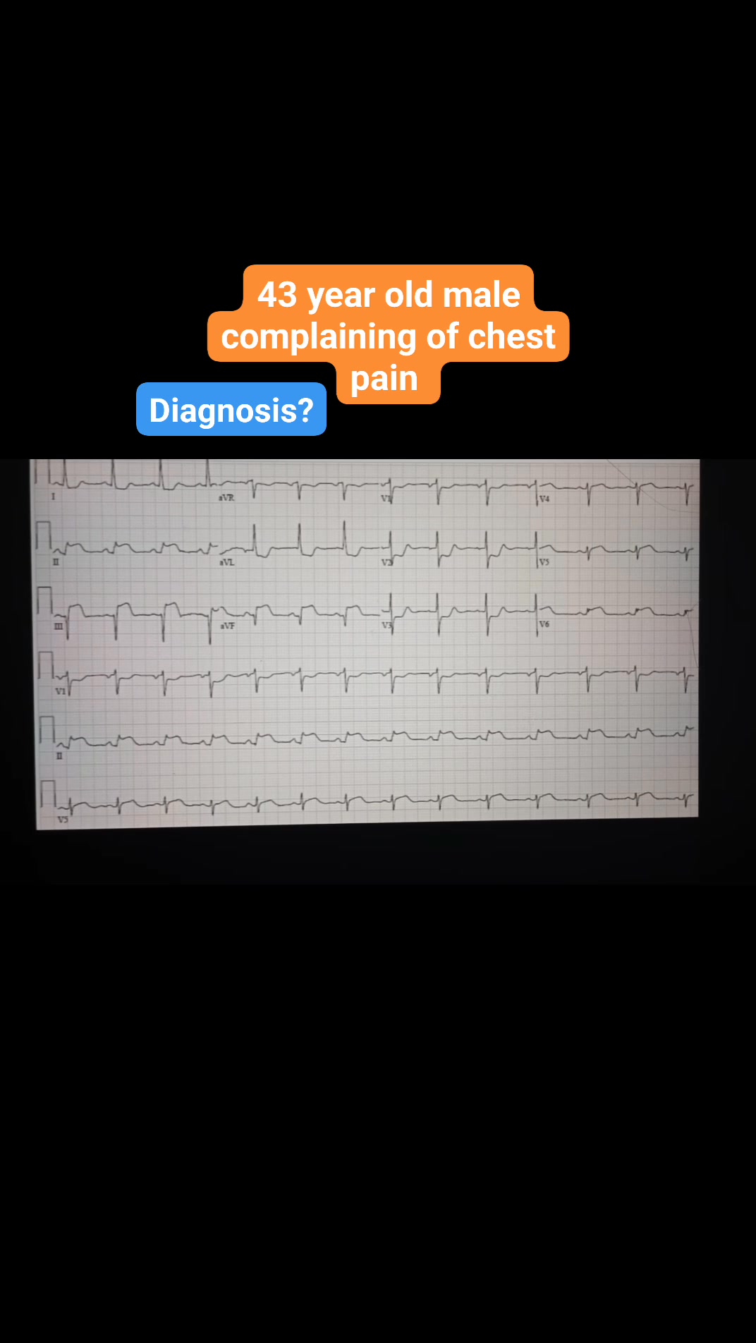 43 year old male patient complaining of chest pain electrocardiogram ...