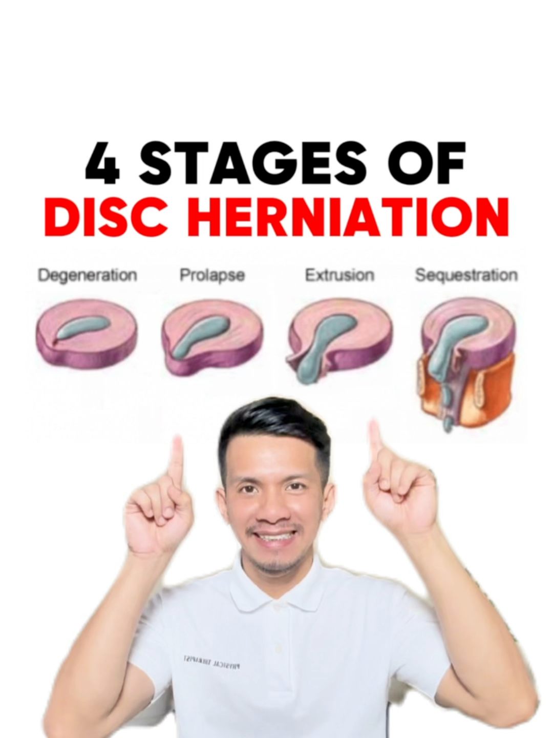 4 STAGES OF HERNIATED DISC AND... - Physical Therapy Session | Facebook