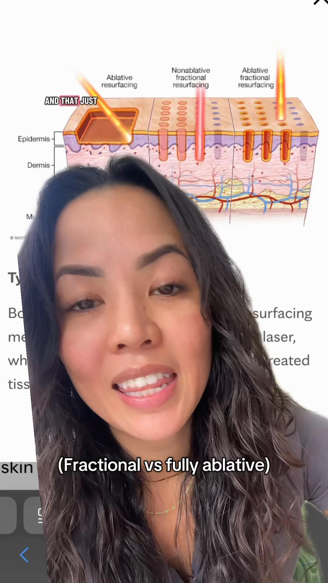 Lasers 101 #lasers #drkieutips #skincare #co2laser