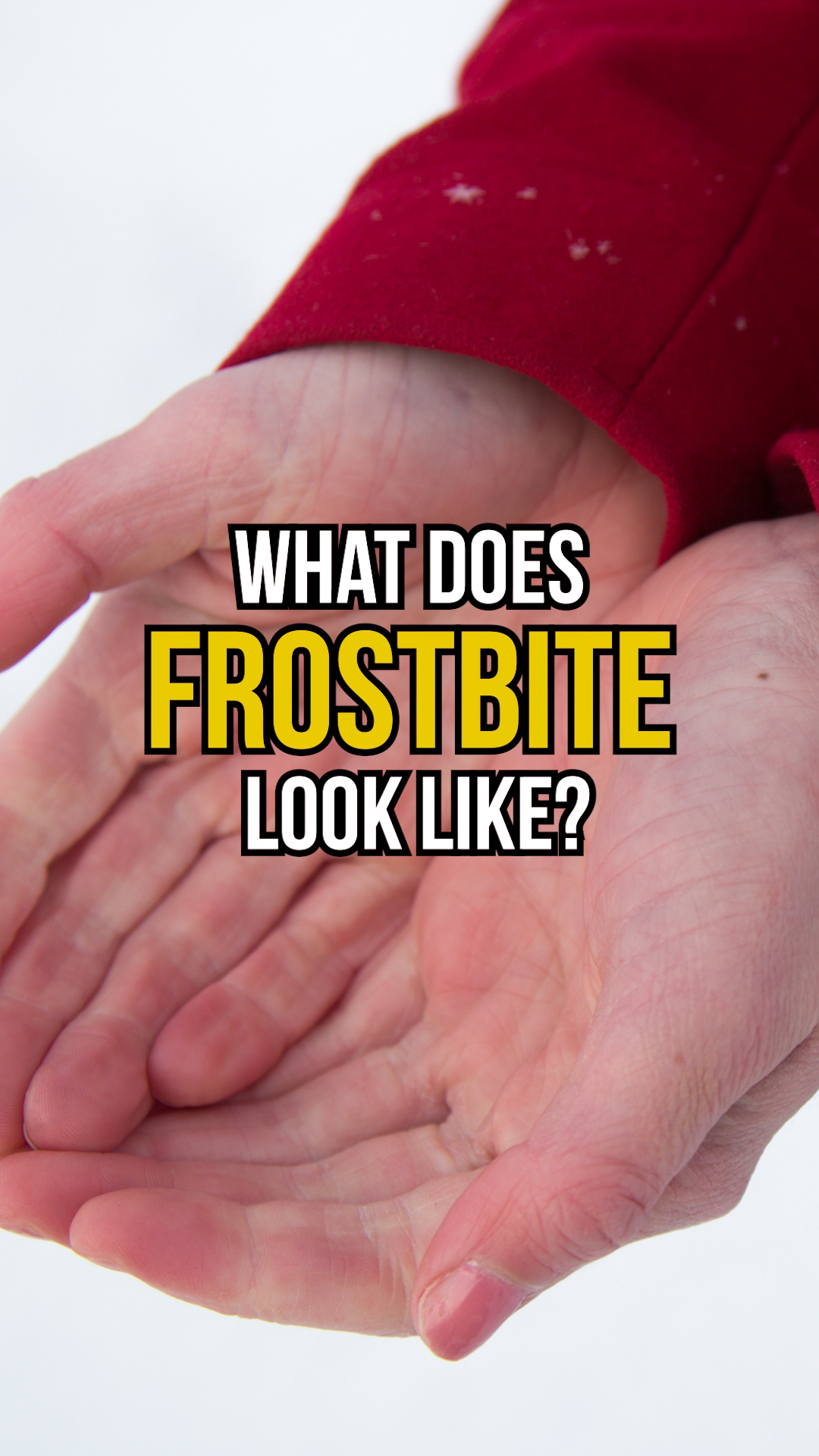 frostbite-can-occur-whenever-temperatures-are-colder-than-32-degrees