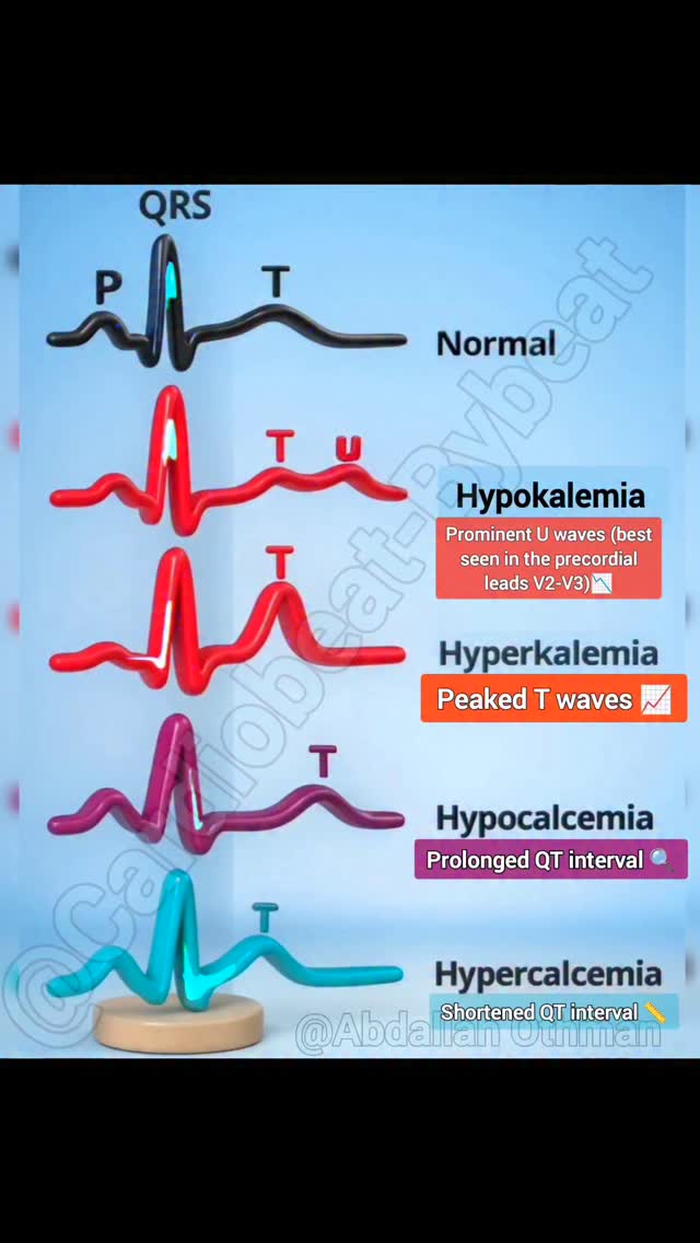 📉🌟 Main Characteristic ECG Changes in Electrolyte Imbalances: Potassium ...