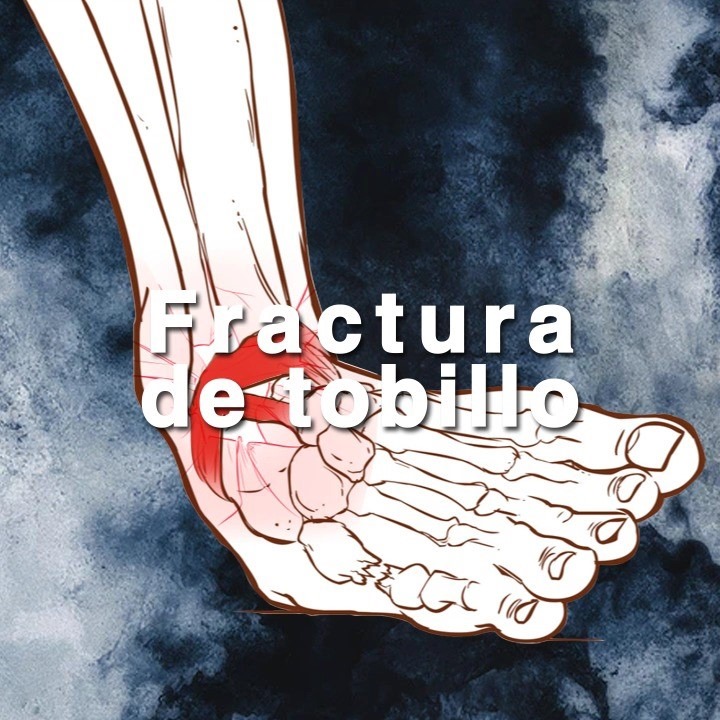 Fractura de tobillo | Producto de cargas excesivas, la ruptura ósea en ...