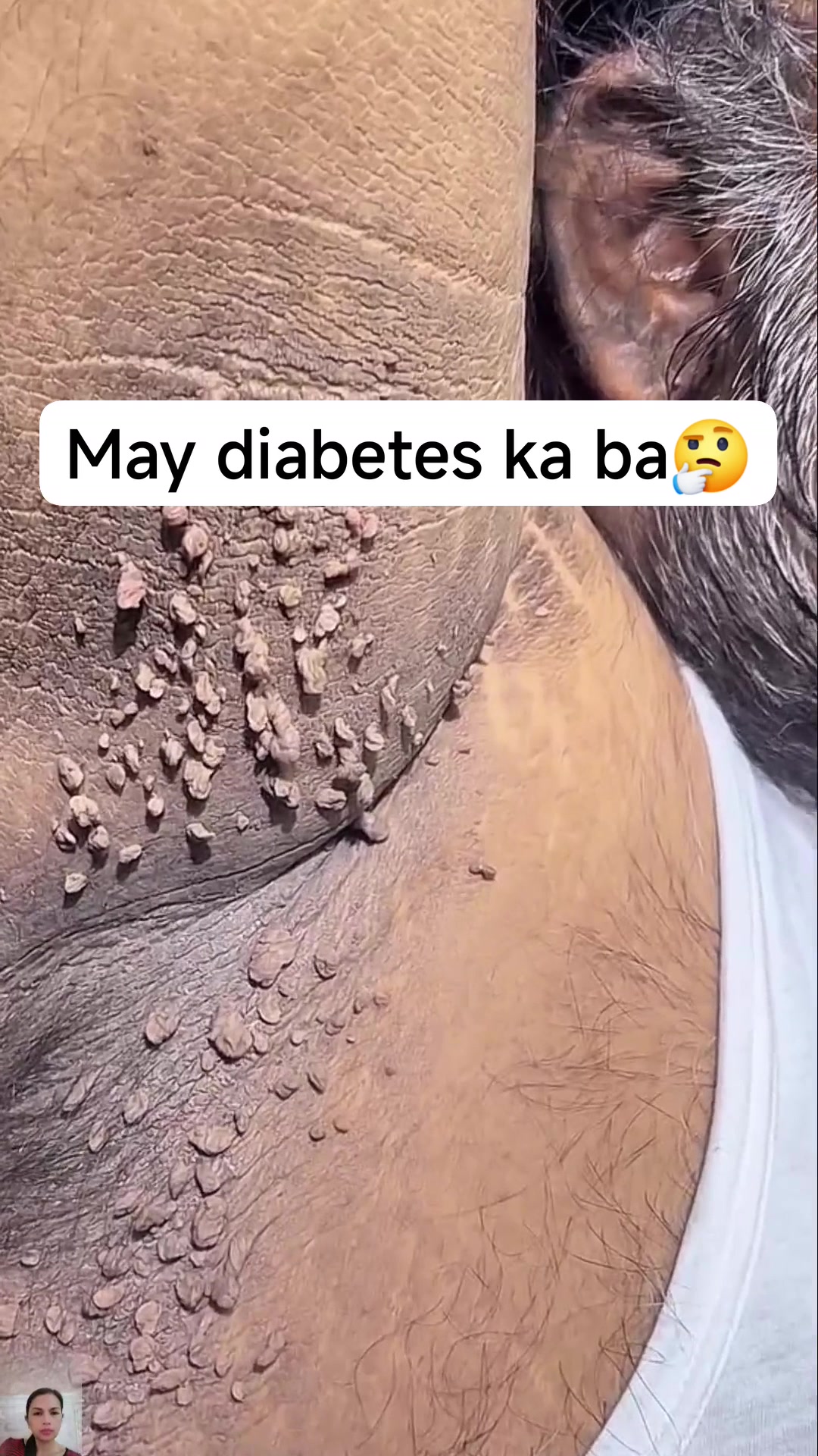 Konektado ang kulugo sa diabetes 👍 #skintags #KULUGO #fyireels # ...