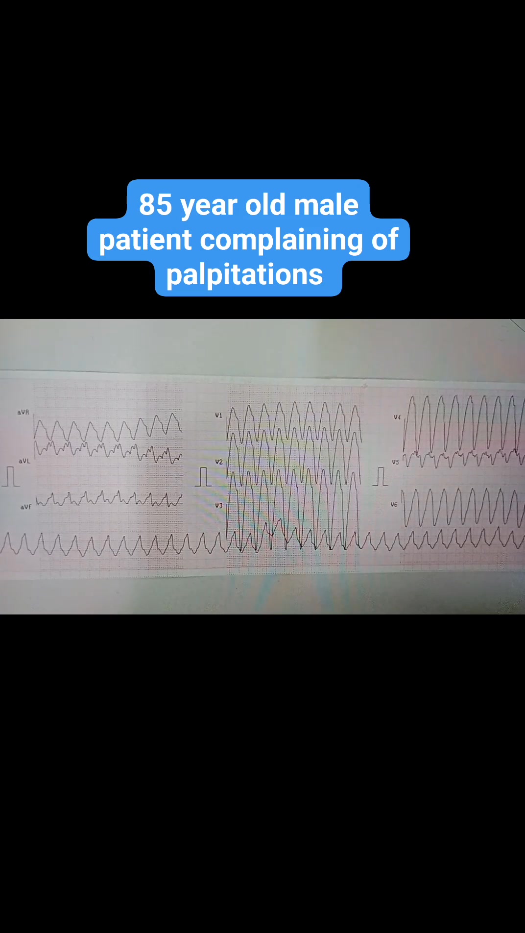 85 year old male patient complaining of palpitations | Cardiology Notes ...