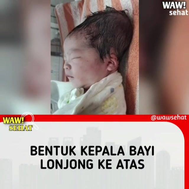 Kamus Kesehatan Bentuk Kepala Bayi Lonjong Ke Atas