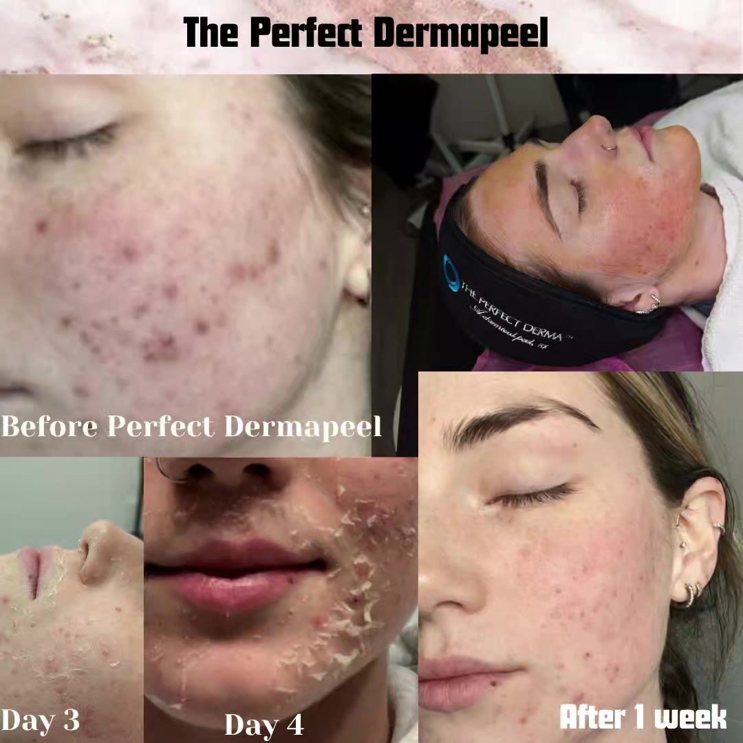 glutathione ingredient in chemical peel New skin just 1 week with the perfect derma peel., MEDICAL GRADE FORMULATION, Powerful ingredients include TCA, Kojic Acid, Retinoic Acid, Salicylic Acid, Phenol, Vitamin C and anti oxidant bpc 157 for herniated Olive oil enriched toner Size:300mcg