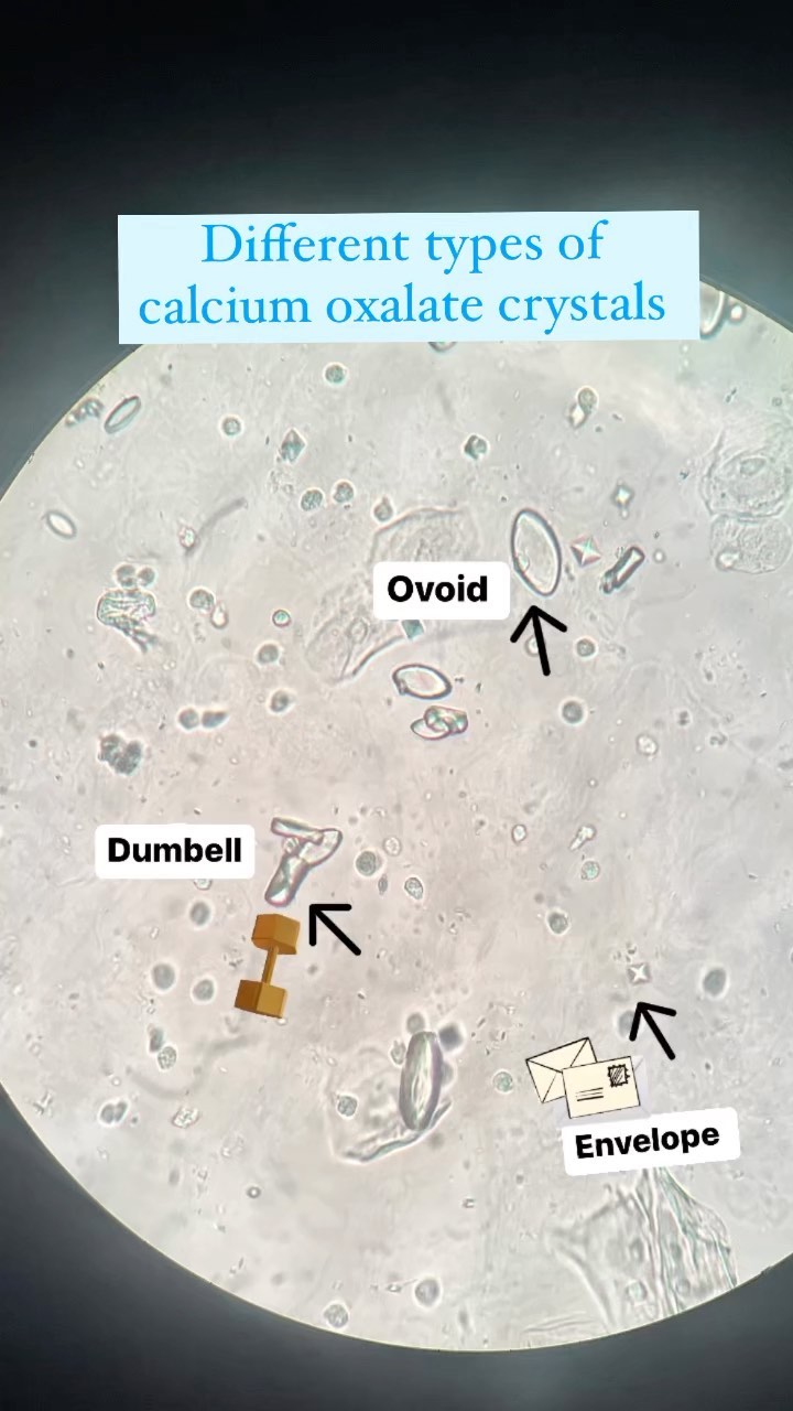 Calcium Oxalate Kidney Stones Microscope Investigation Of Potential