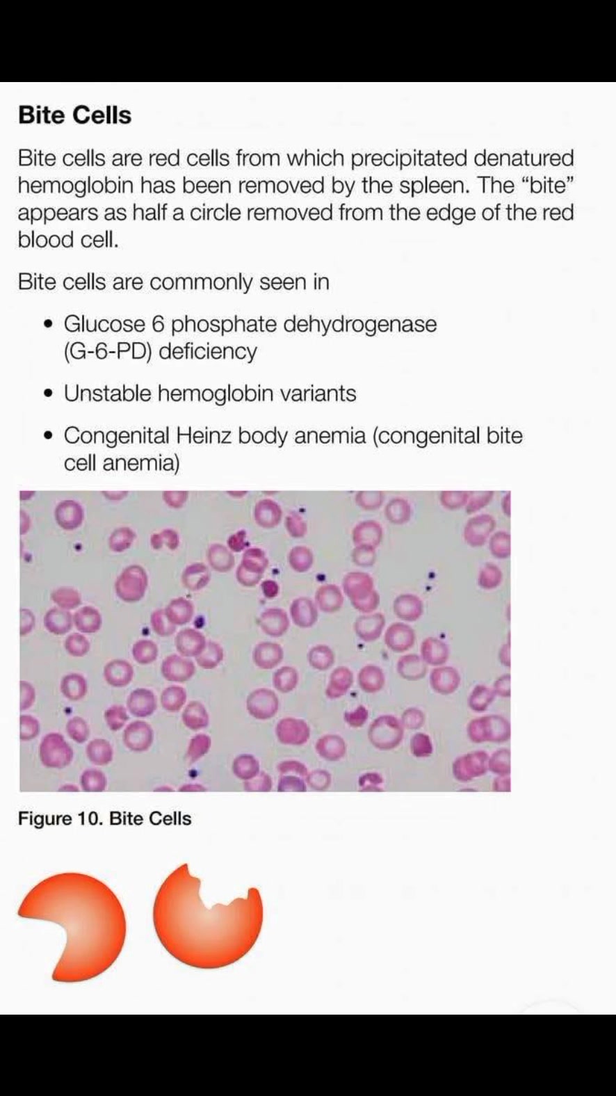 🌺 Blister Cell in G6PD Deficiency 🌺, 🔸Red Blood Cell with a clear vacuole-like area on its membrane, resembling a blister., 🔸It usually results when splenic macrophages remove precipitated Heinz 