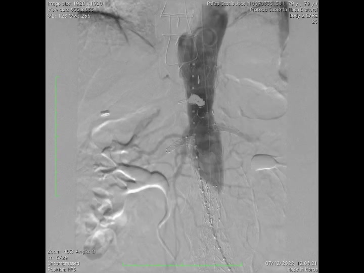ANEURISMA DE AORTA ABDOMINAL PARARRENAL Los aneurismas aórticos ...