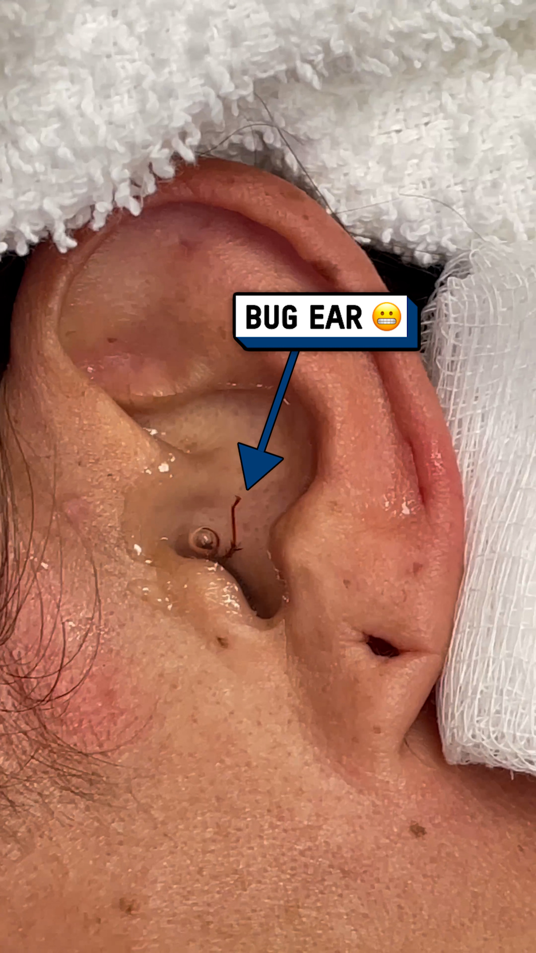 The doctors found this inside my ear... 🪳😱 #insects #medical #gross ...