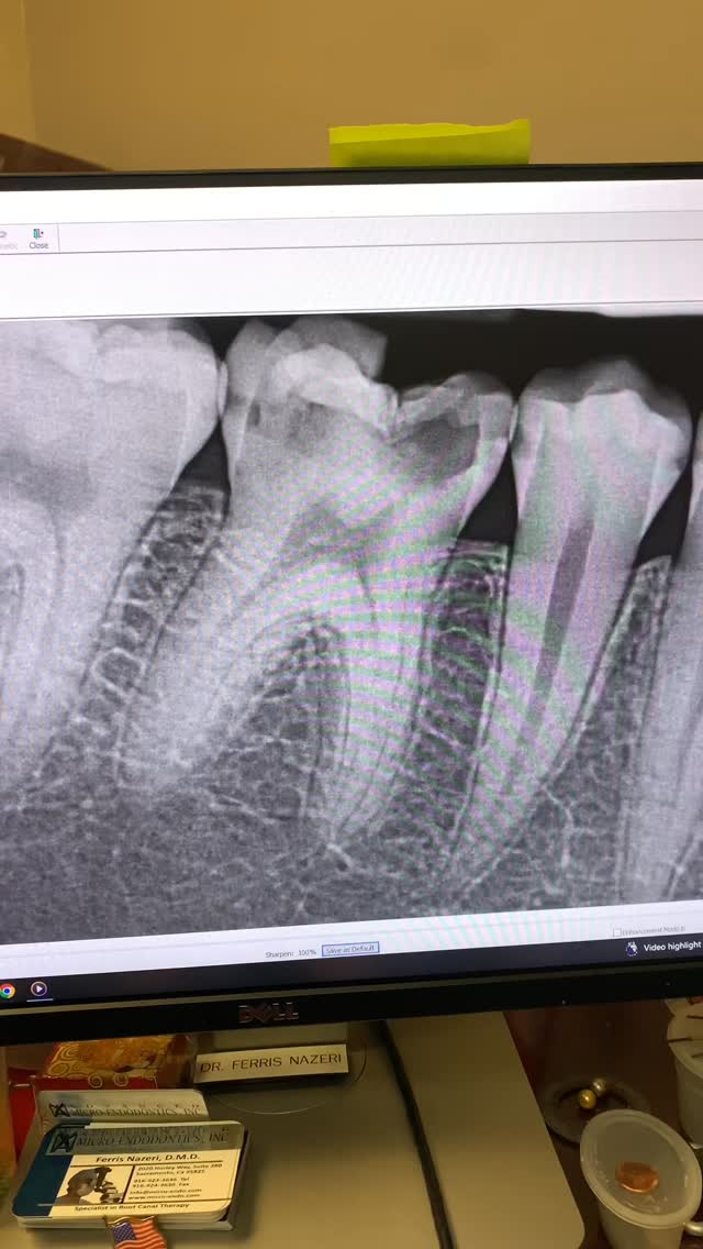 POV clinical video of root canal treatment of tooth 30 from start to ...