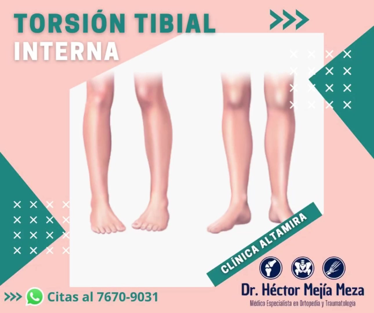 La torsión tibial interna es una de las causas de los dedos del pie ...