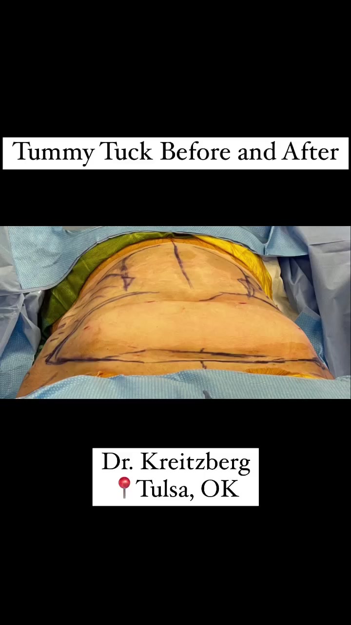 Tummy Tuck Before and After with Dr. Kreitzberg 📍Tulsa, OK 📲 918-940 ...
