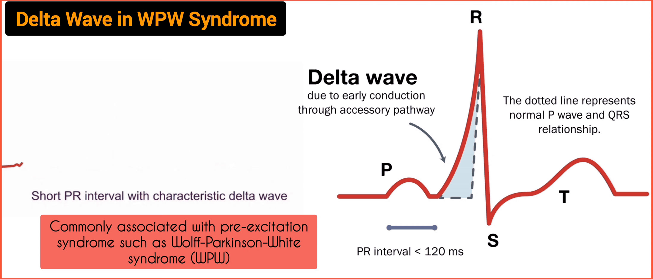 Delta Wave in WPW syndrome (PR