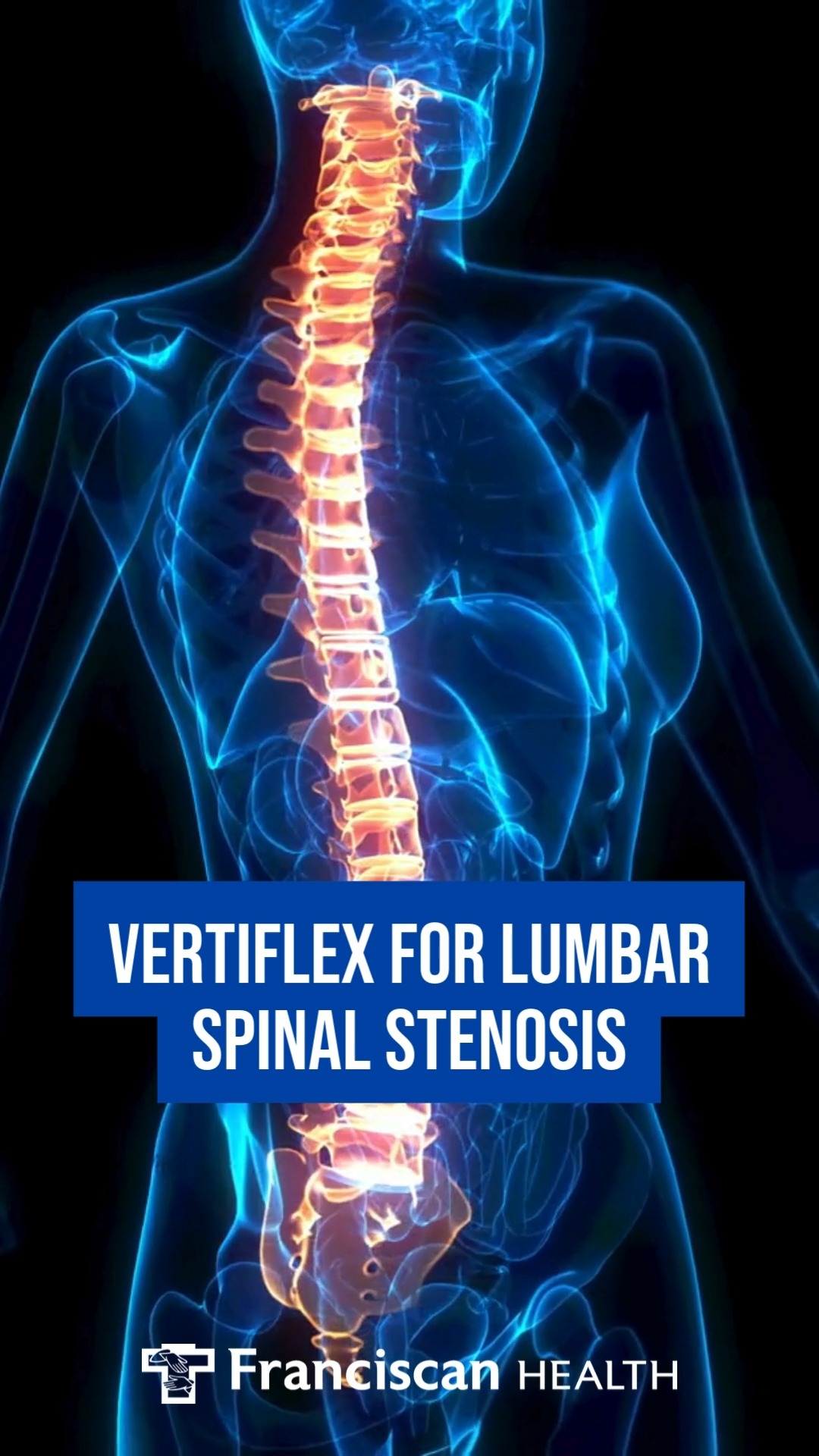 You can think of Vertiflex as a doorstop in the spine since its job is ...