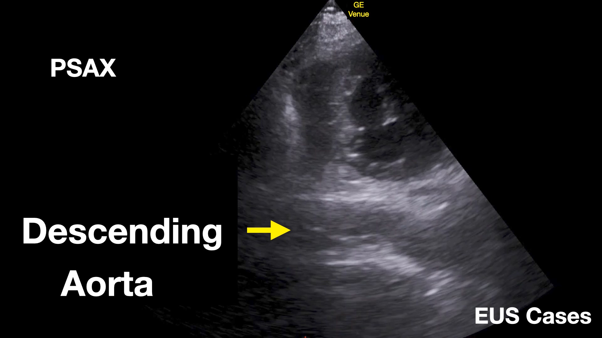 POCUS view ในท่า Parasternal short axis view (PSAX) สามารถใช้ดู aortic ...