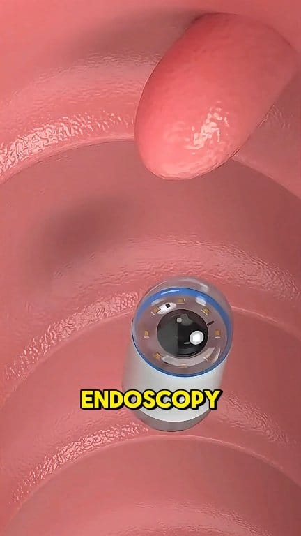 Capsule Endoscopy (3D Animation) #capsule #endoscopy #capsuleendoscopy ...