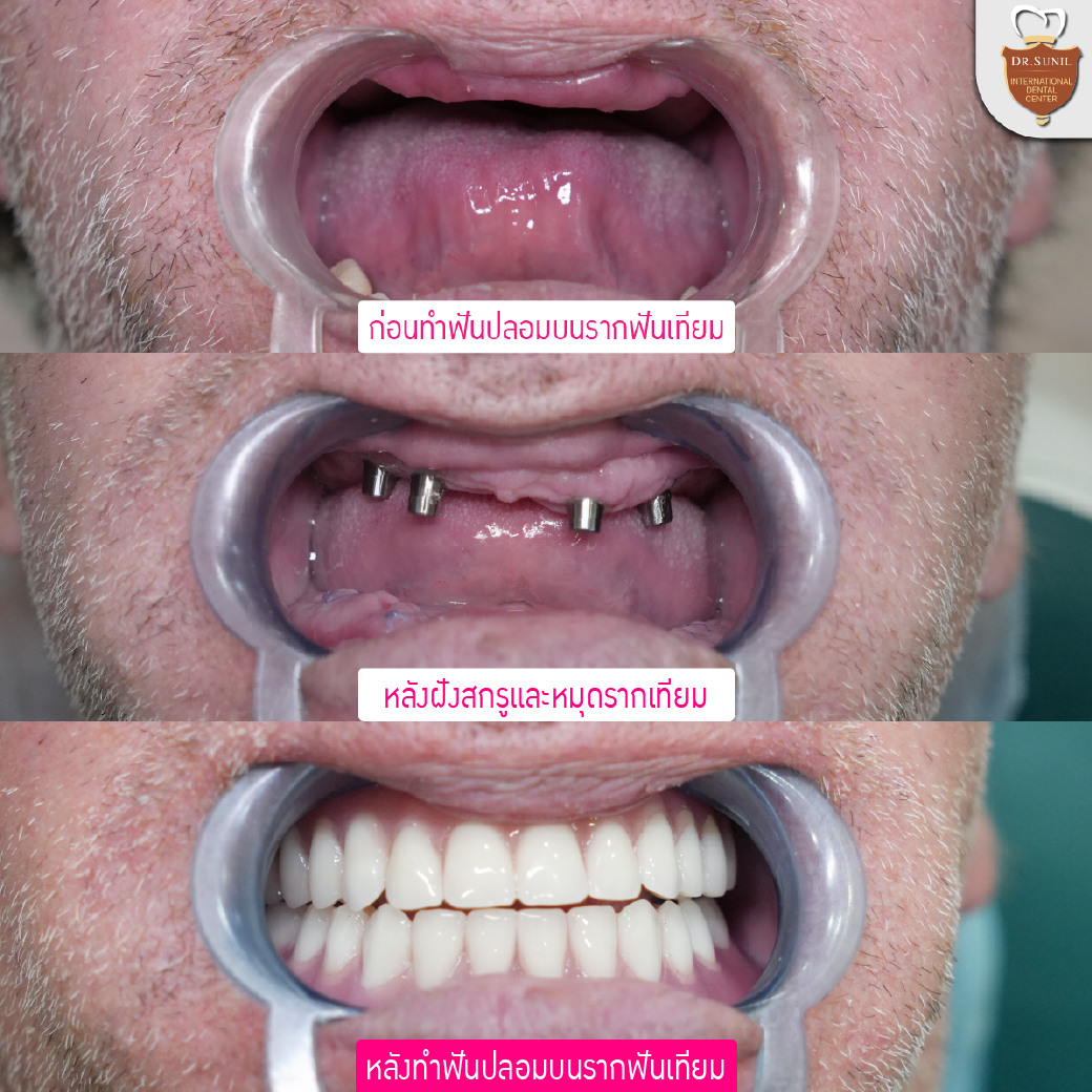เส้นทางสู่รอยยิ้มที่สมบูรณ์แบบของคนไข้จากนิวซีแลนด์! 🦷 💖 All On 4 ฟัน ...