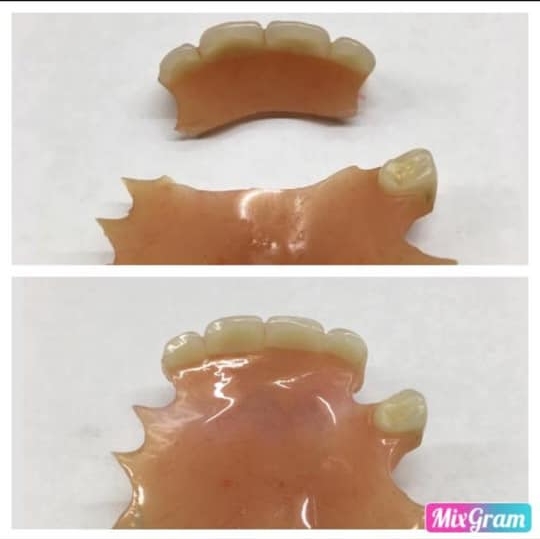 Denture Repairs | Manchester
