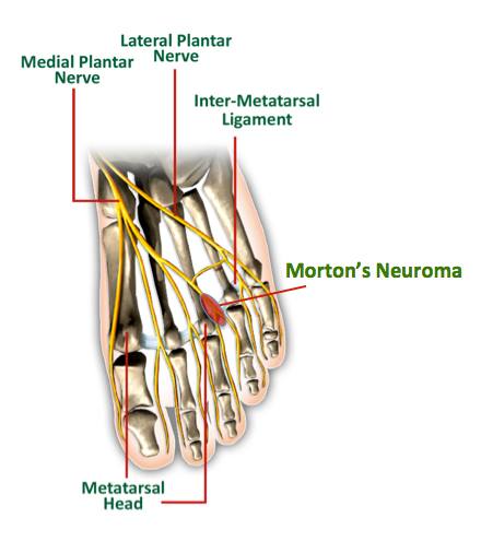 The Center - Where is YOUR Morton's pain? Morton’s neuroma occurs ...