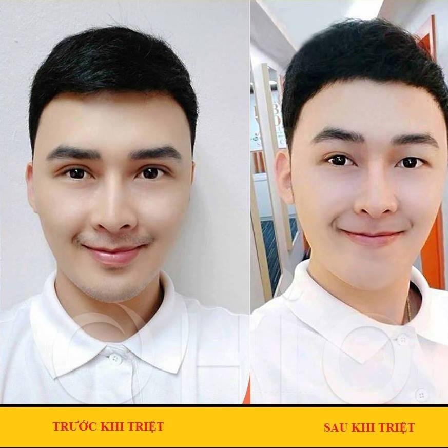 Triệt Râu Vĩnh Viễn Tại Nhà