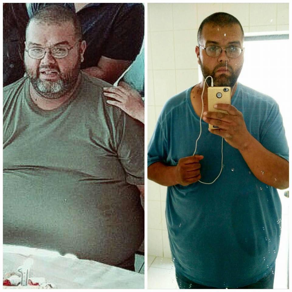 Gastric Bypass Before And After Pictures Men