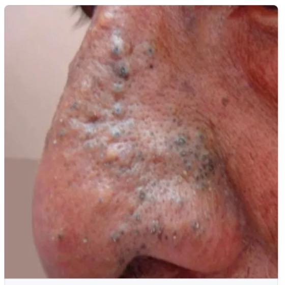 Pimple Blackheads Cyst 2024 | Facebook