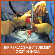Hip Replacement Surgery Cost in India