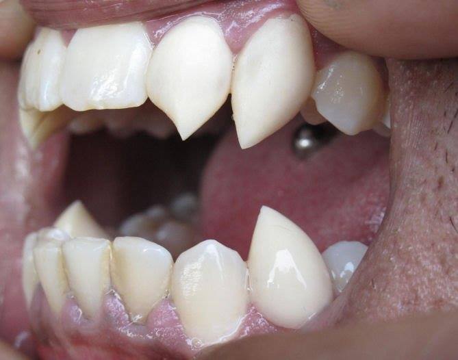 Custom Made Fangs By New Age Modifications