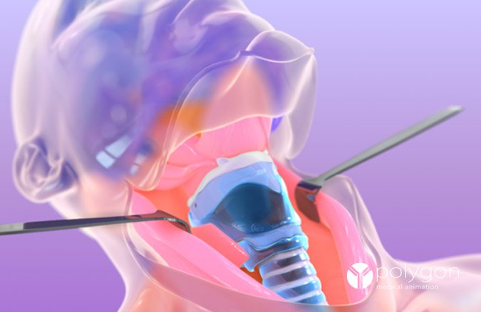 More about total laryngectomy