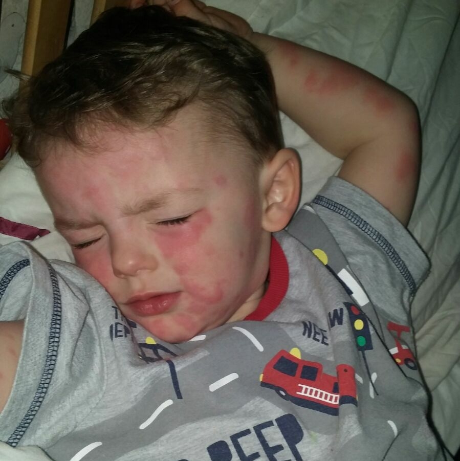 Ashton-jai Rouse Hot Rash