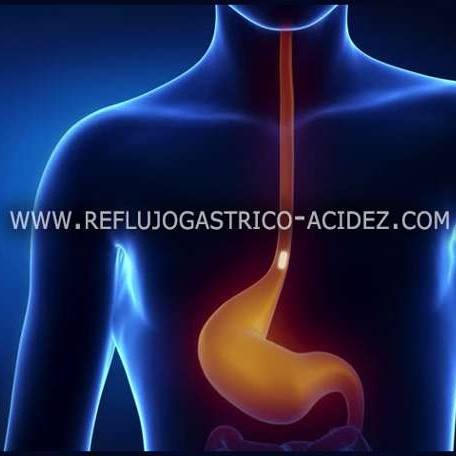 Reflujo Gástrico - Acidez