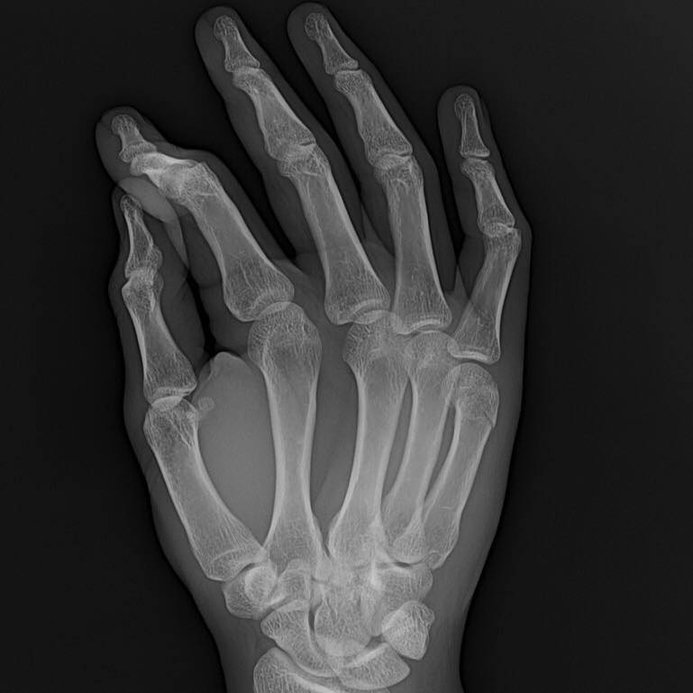 Bones & Joints Clinic - Femoral notching during TKA weakens the cortex ...