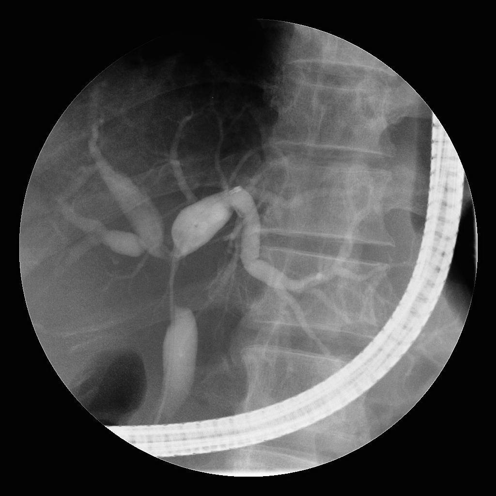 ERCP - The Art and Science of Procedure