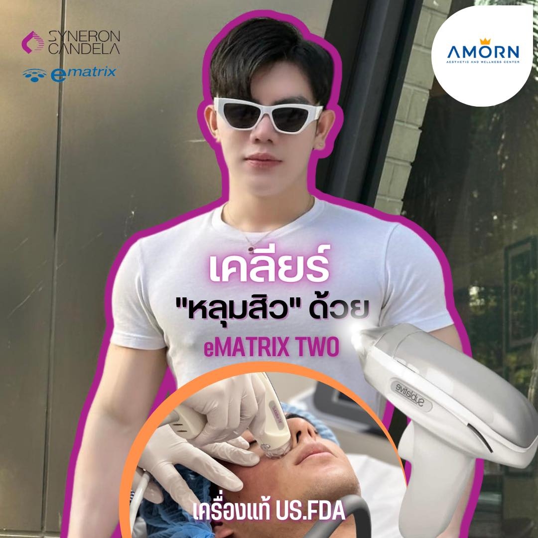 Ematrix acne scars หลุมสิว รูขุมขน รอยแผลเป็น | Bangkok