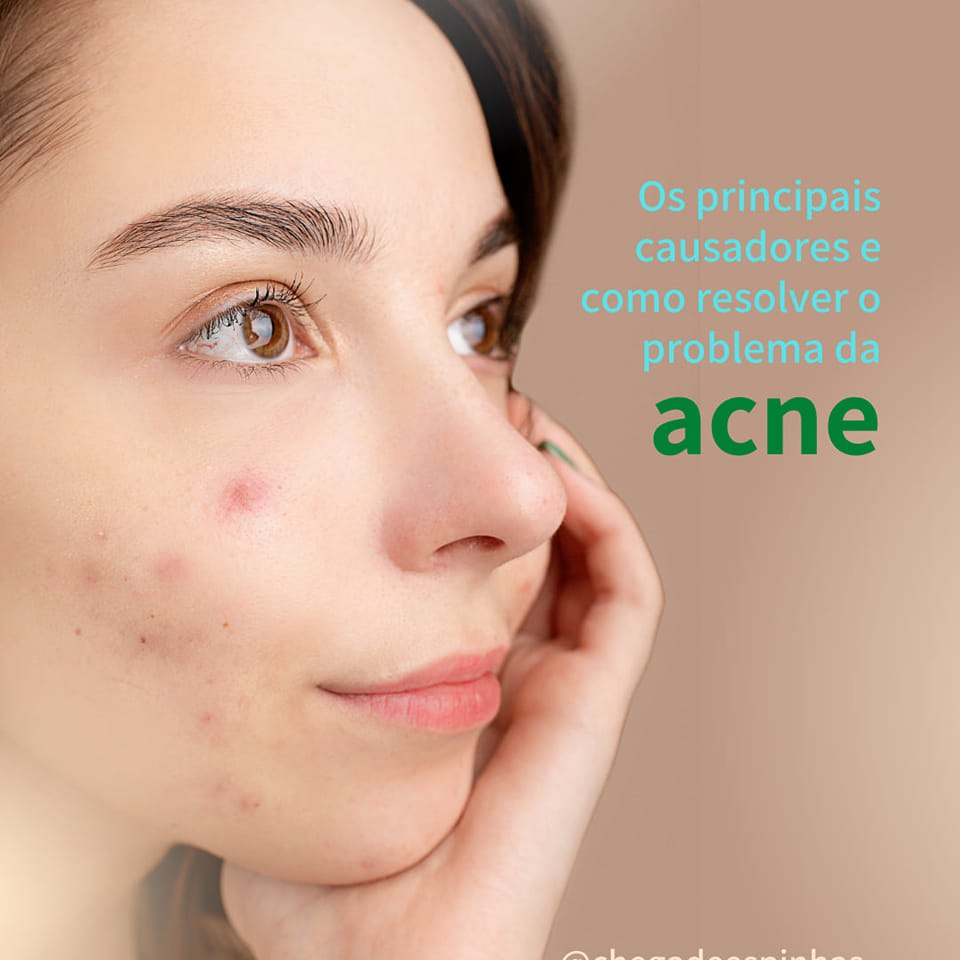Bay bay Acne | Curitiba PR
