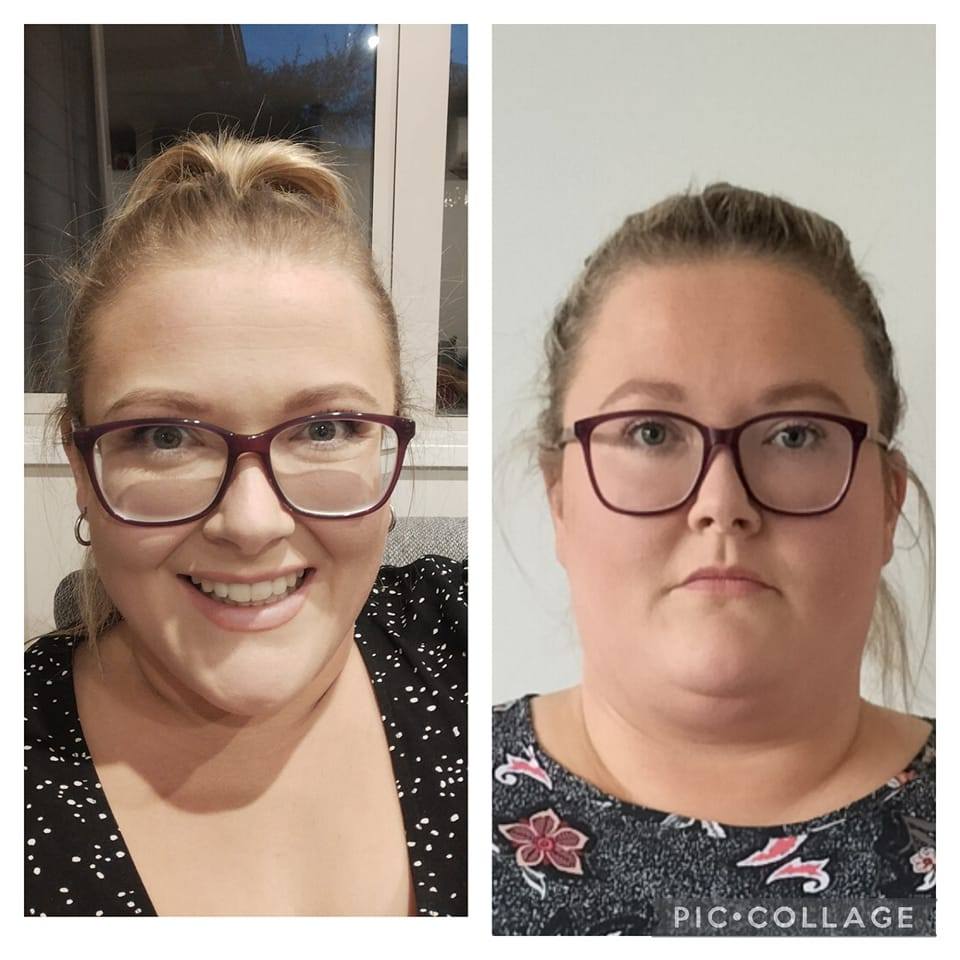 Mini Gastric Bypass Before And After Mini Bypass Package In Cancun,