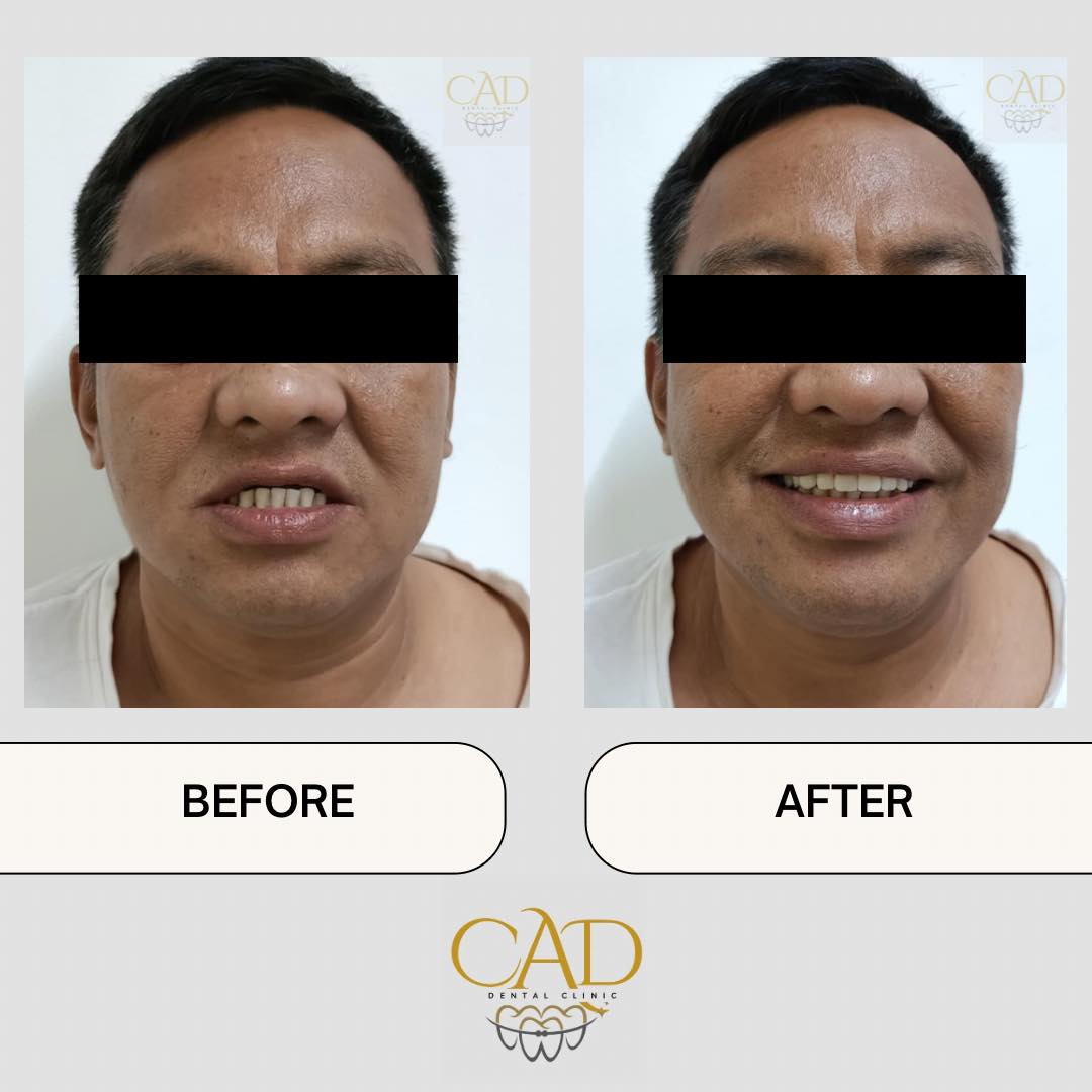 CAD - Another smile transformation! 😍 Our patient wearing our natural ...