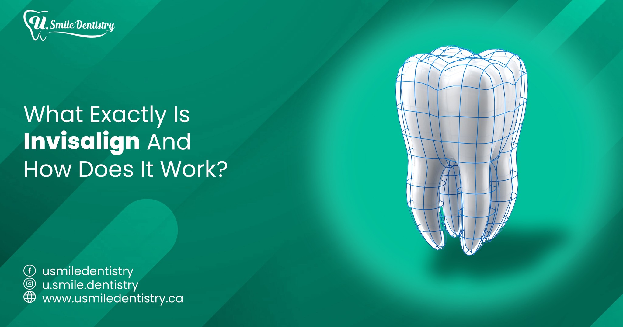 U Smile - What Exactly Is Invisalign and How Does It Work? Invisalign ...