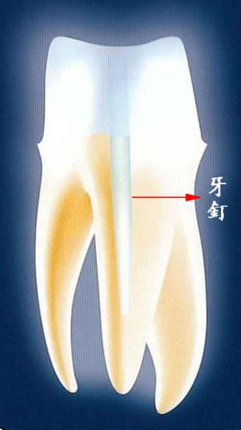 門牙根管治療 新竹竹北晴美牙醫診所