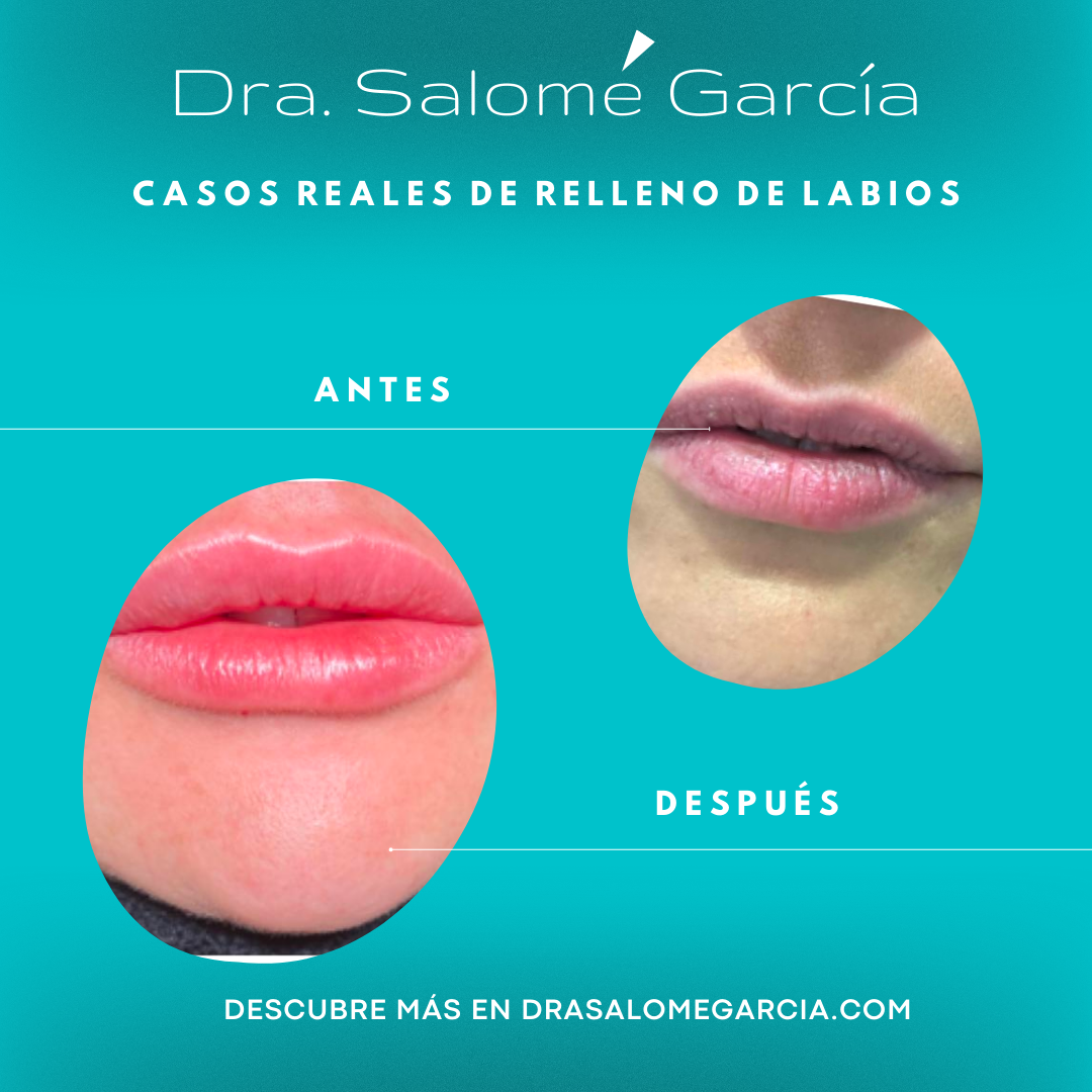 Doctora Salomé García - 🦷 Casos Reales de Relleno de Labios con Ácido ...