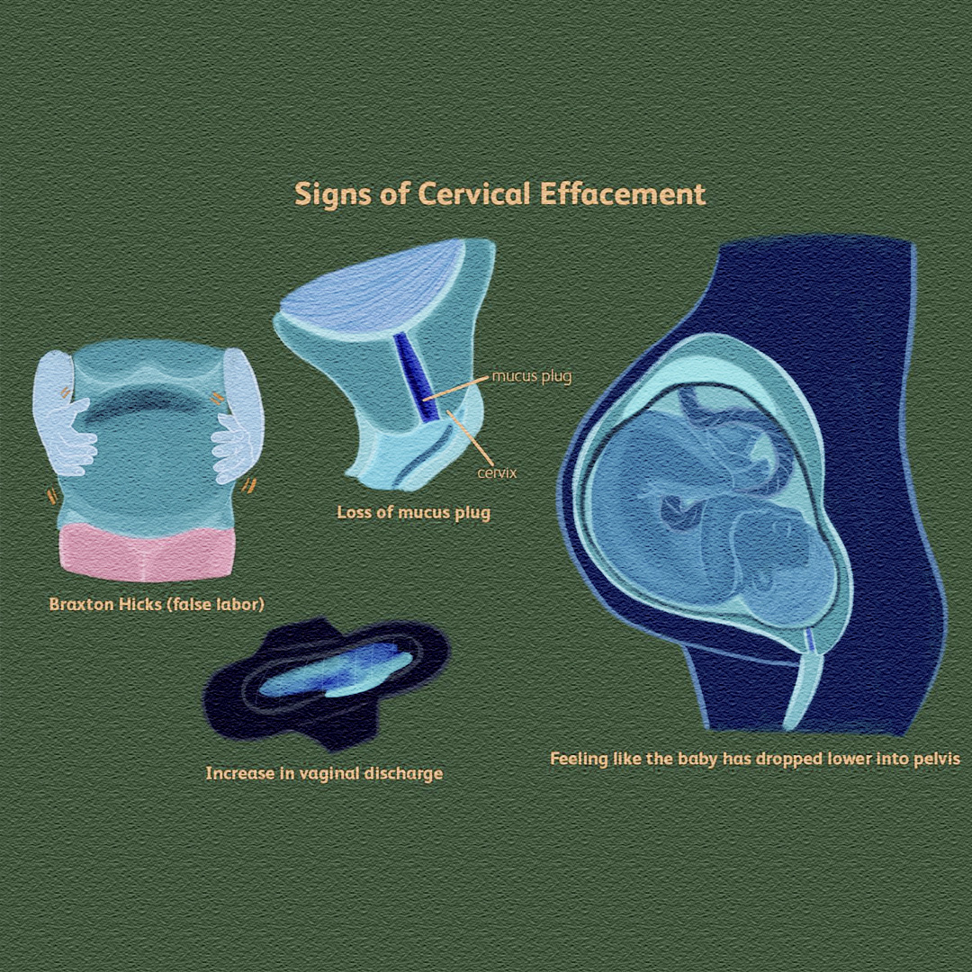Cervical Effacement Stages: Your... - Pregnancy & Parenting | Facebook