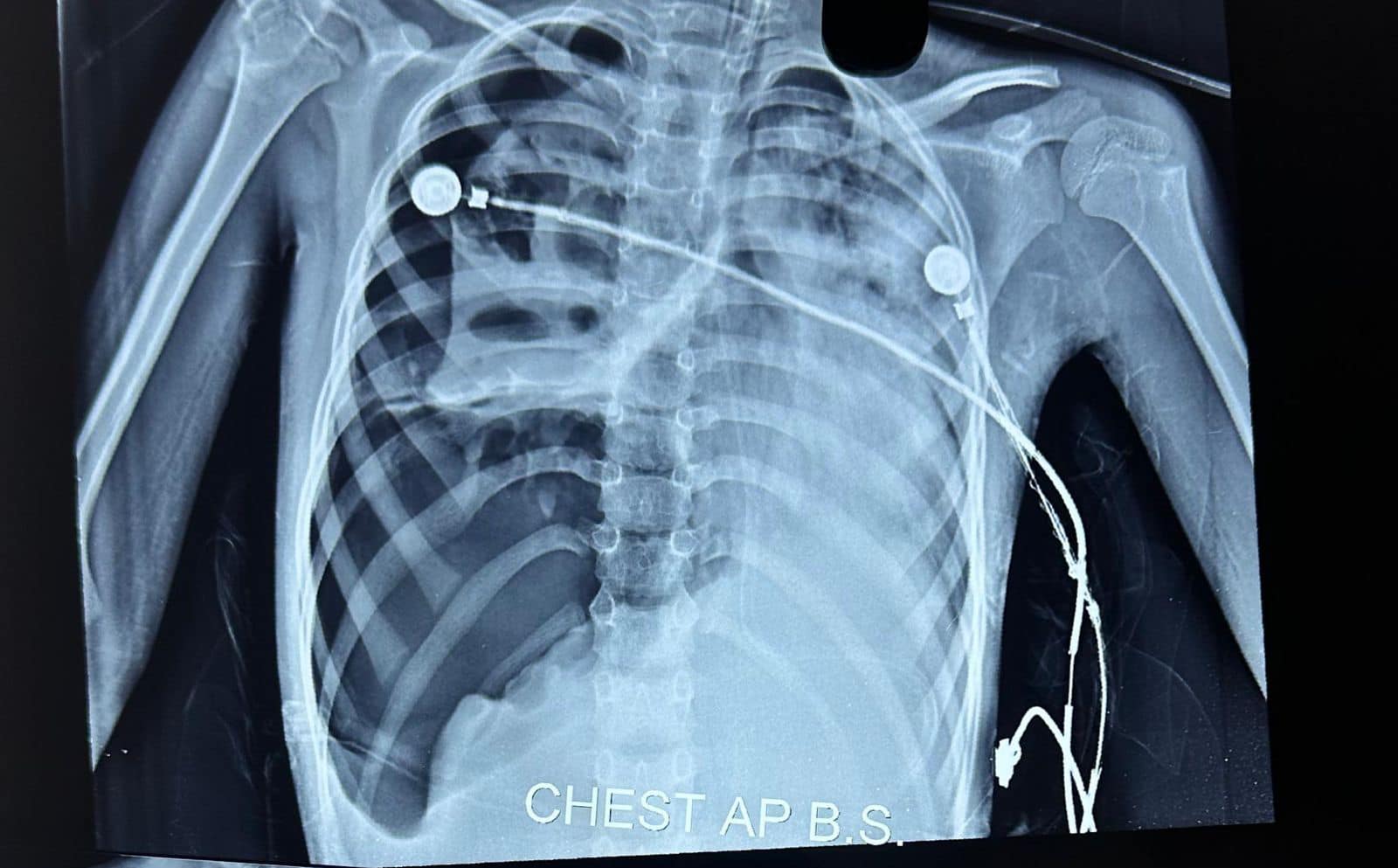 Infant Pneumothorax X Ray The Neonatal Chest X Ray