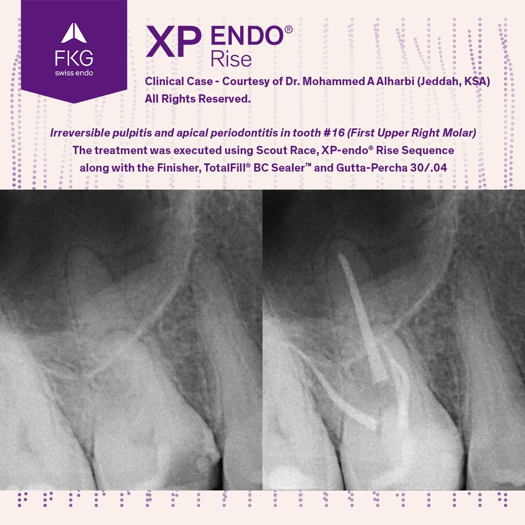 FKG - 🦷🤩 Clinical case by Dr. Mohammed A Alharbi, using XP-endo Rise ...