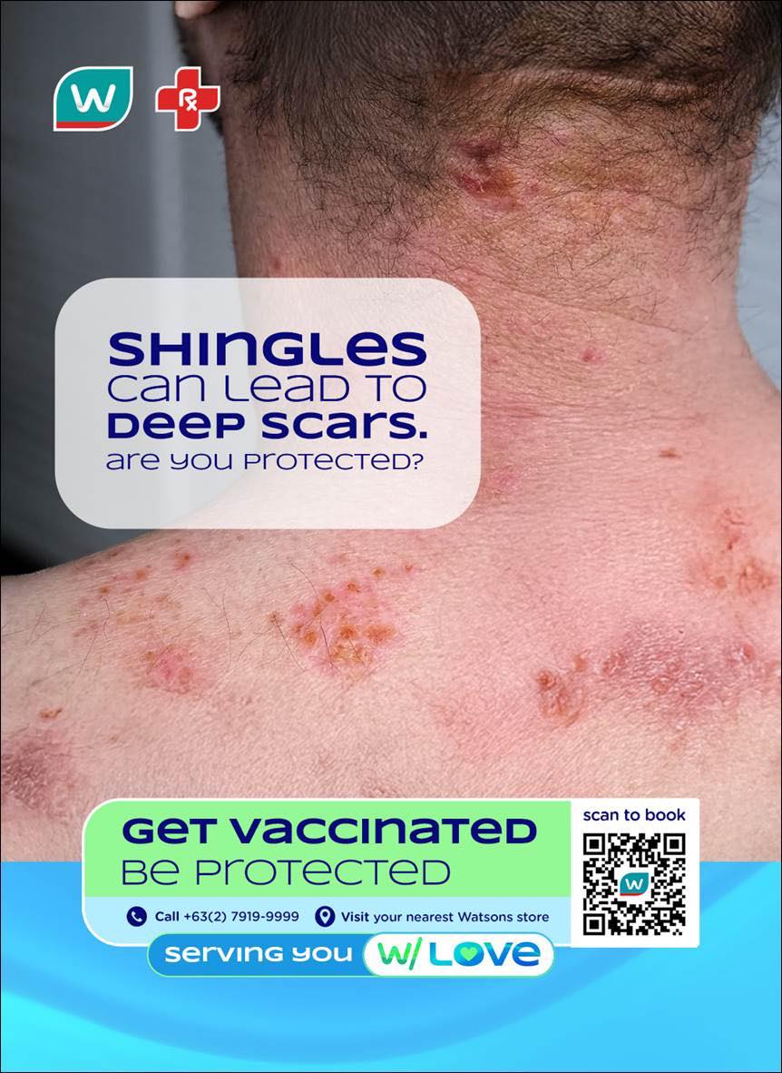 SM - Shingles can be more than just a painful rash—it can lead to ...