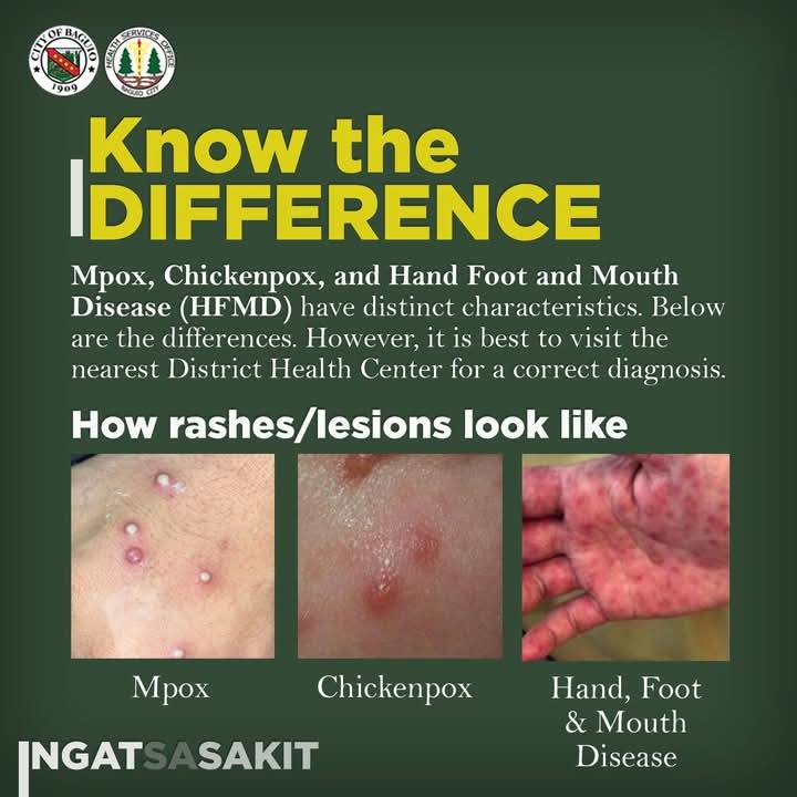 𝗞𝗡𝗢𝗪 𝗧𝗛𝗘 𝗗𝗜𝗙𝗙𝗘𝗥𝗘𝗡𝗖𝗘 Mpox,... - Surigao News Update | Facebook