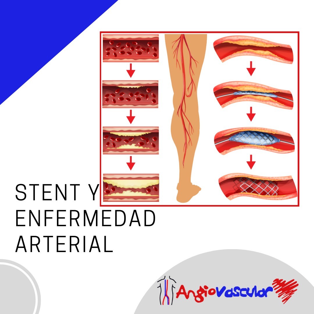 Angiovascular - Angiopasltía y Stent para Enfermedad Arterial La ...